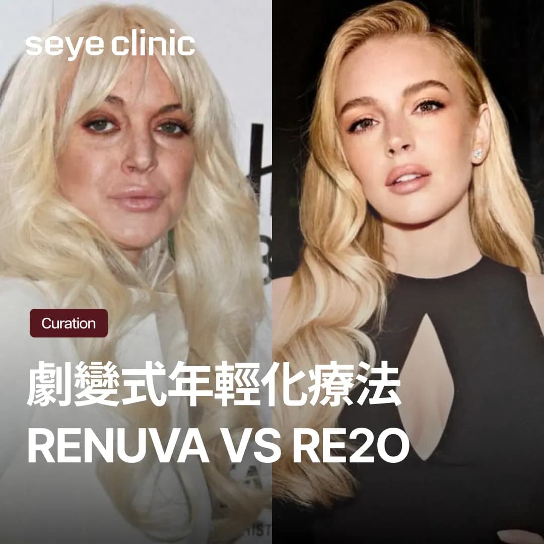琳賽蘿涵選擇的Renuva？韓國無法施作的原因與替代方案Re2O效果