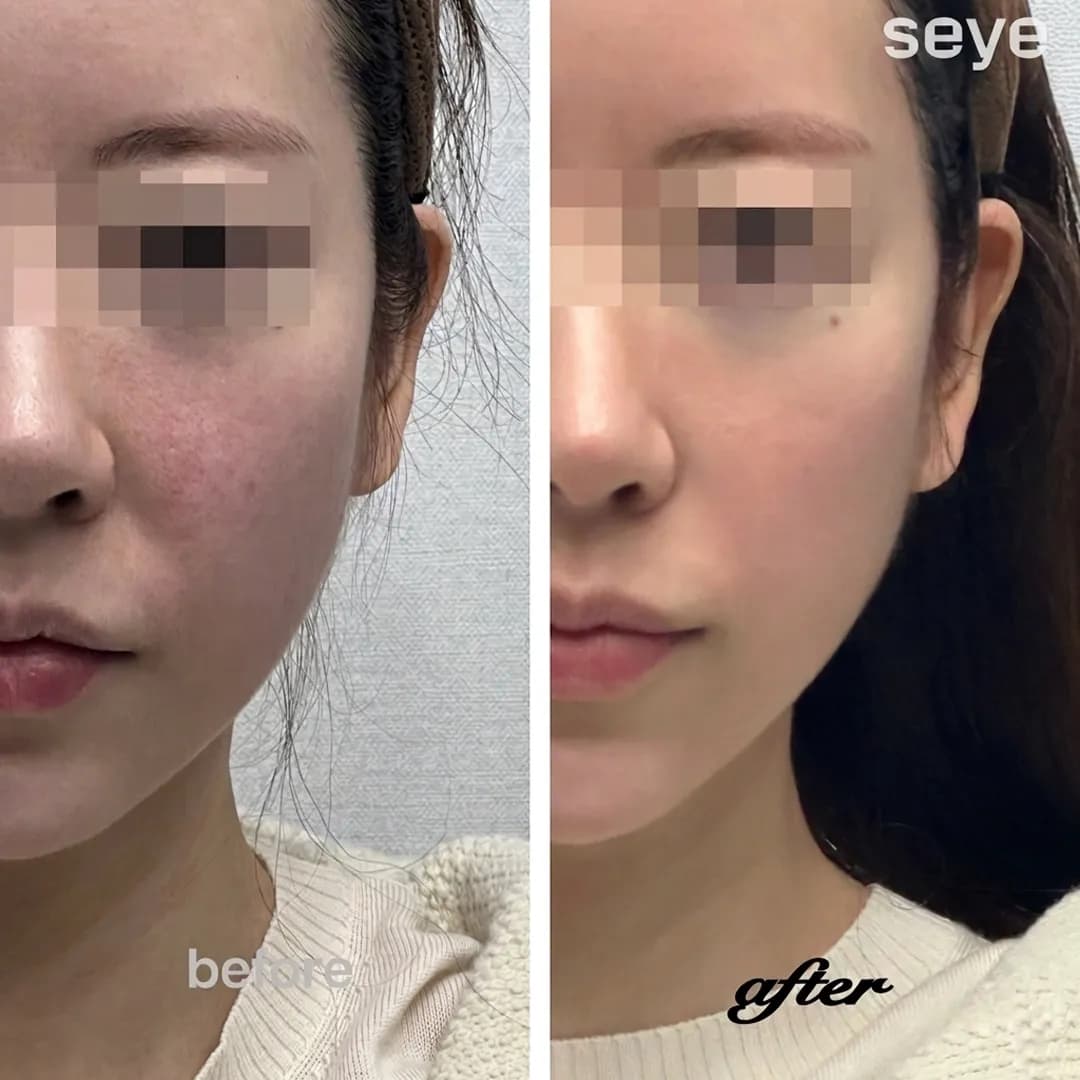 BBL Laser in Seoul: Complete Guide to Pigmentation and Redness Treatment