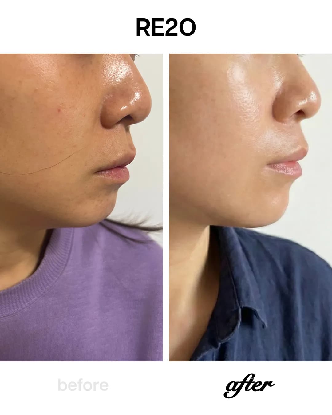 Re2O skin booster treatment for skin regeneration and pore tightening at Seye Clinic.