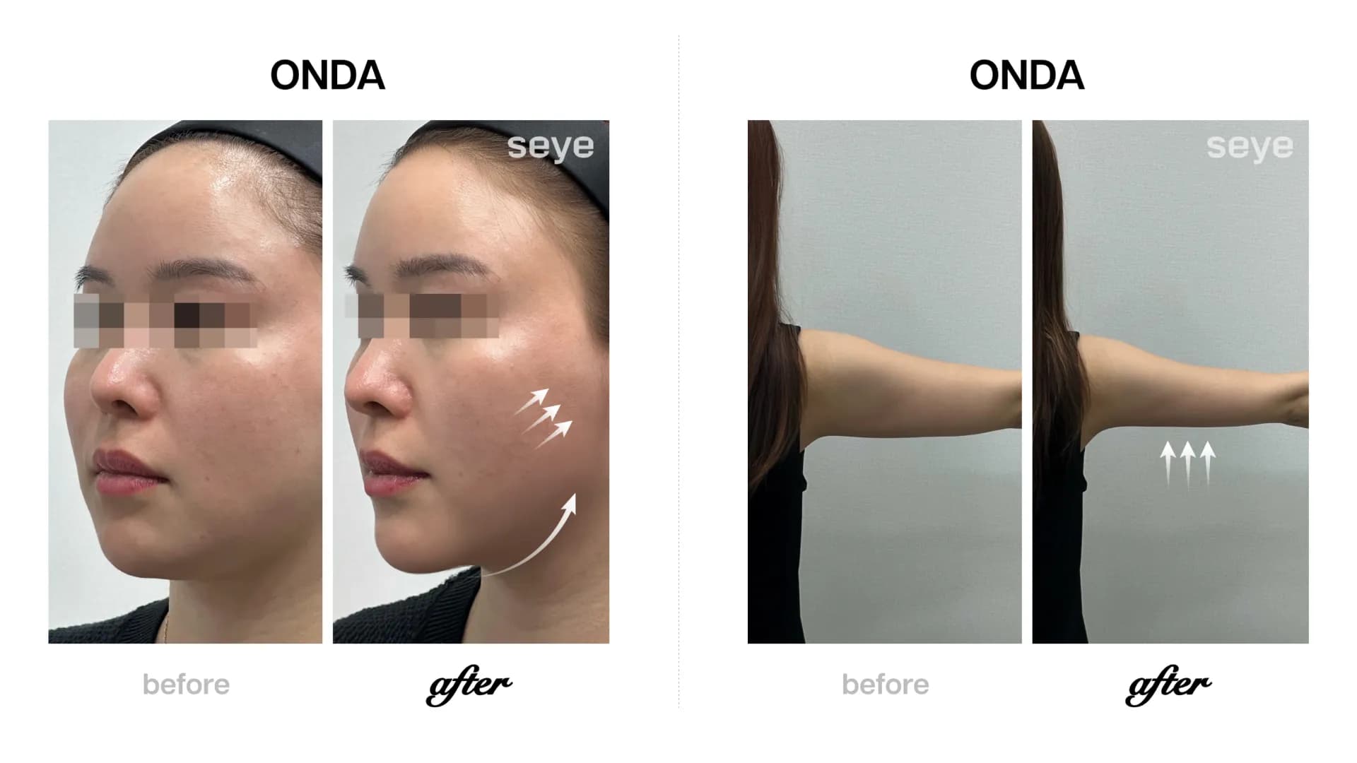 ONDA lifting treatment for facial contouring at Seye Clinic Seoul.