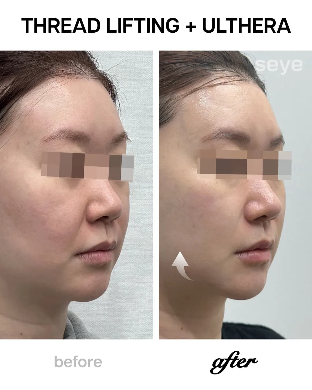 Multi-modal treatment: Silhouette Soft for structural lift and Ultherapy/Thermage for deep skin tightening to achieve a durable, sharp jawline.
