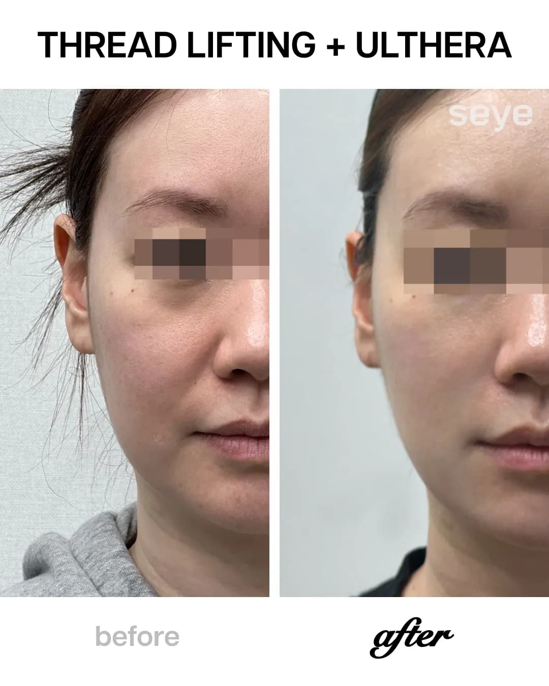 Multi-modal treatment: Silhouette Soft for structural lift and Ultherapy/Thermage for deep skin tightening to achieve a durable, sharp jawline.