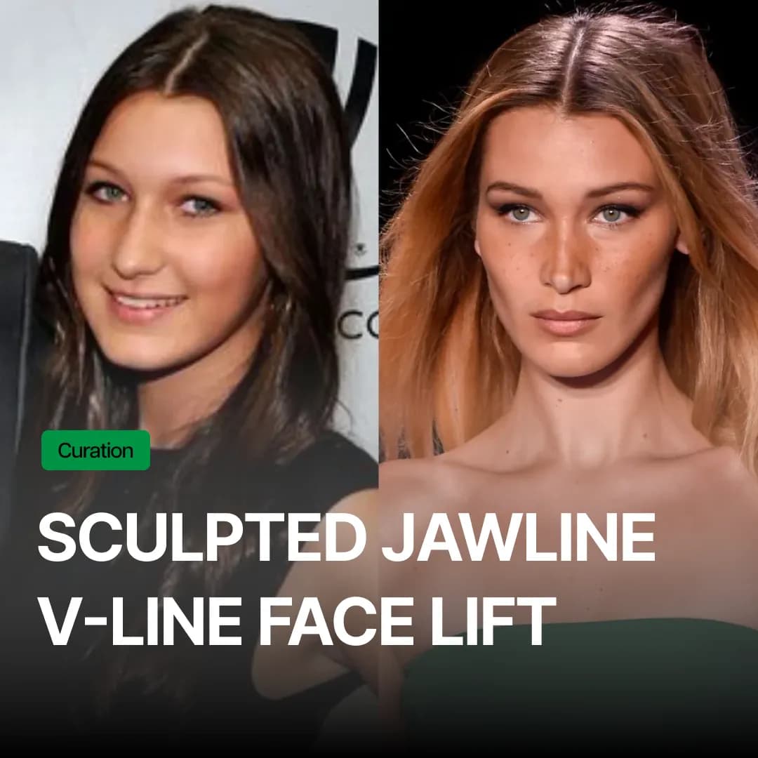 Silhouette Soft: The Ultimate Secret to a Sculpted V-Line & Long-Term Collagen Lift