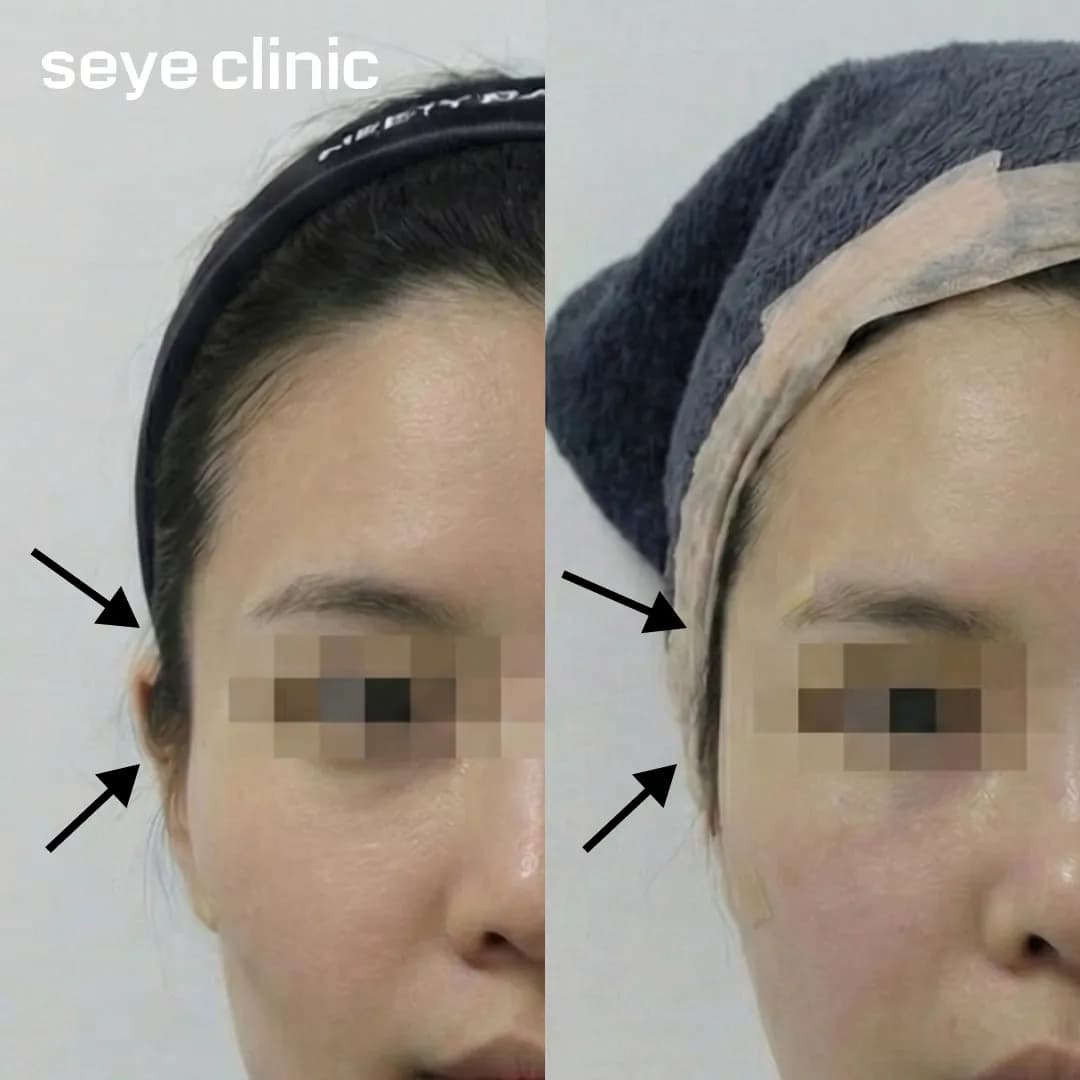 Before and after photos of a patient's profile showing significant improvement in temple hollowing and a smoother facial contour after Ellanse temple filler at Seye Clinic.