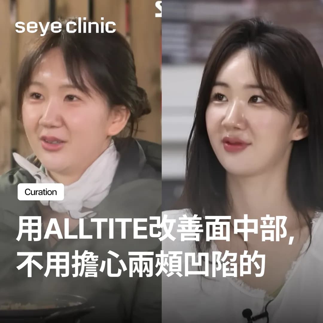 玉純同款提拉秘訣:用Alltite改善面中部,不用擔心兩頰凹陷的自然提拉