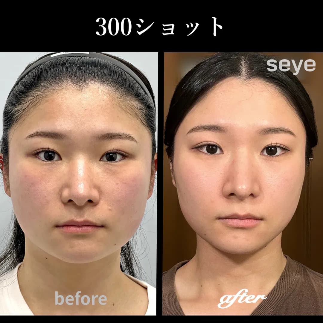 ウルセラピープライム__300ショット_ビフォーアフター.jpg