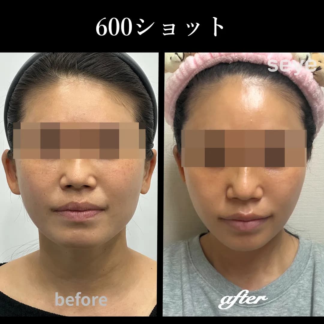 ウルセラピープライム__600ショット_ビフォーアフター.jpg