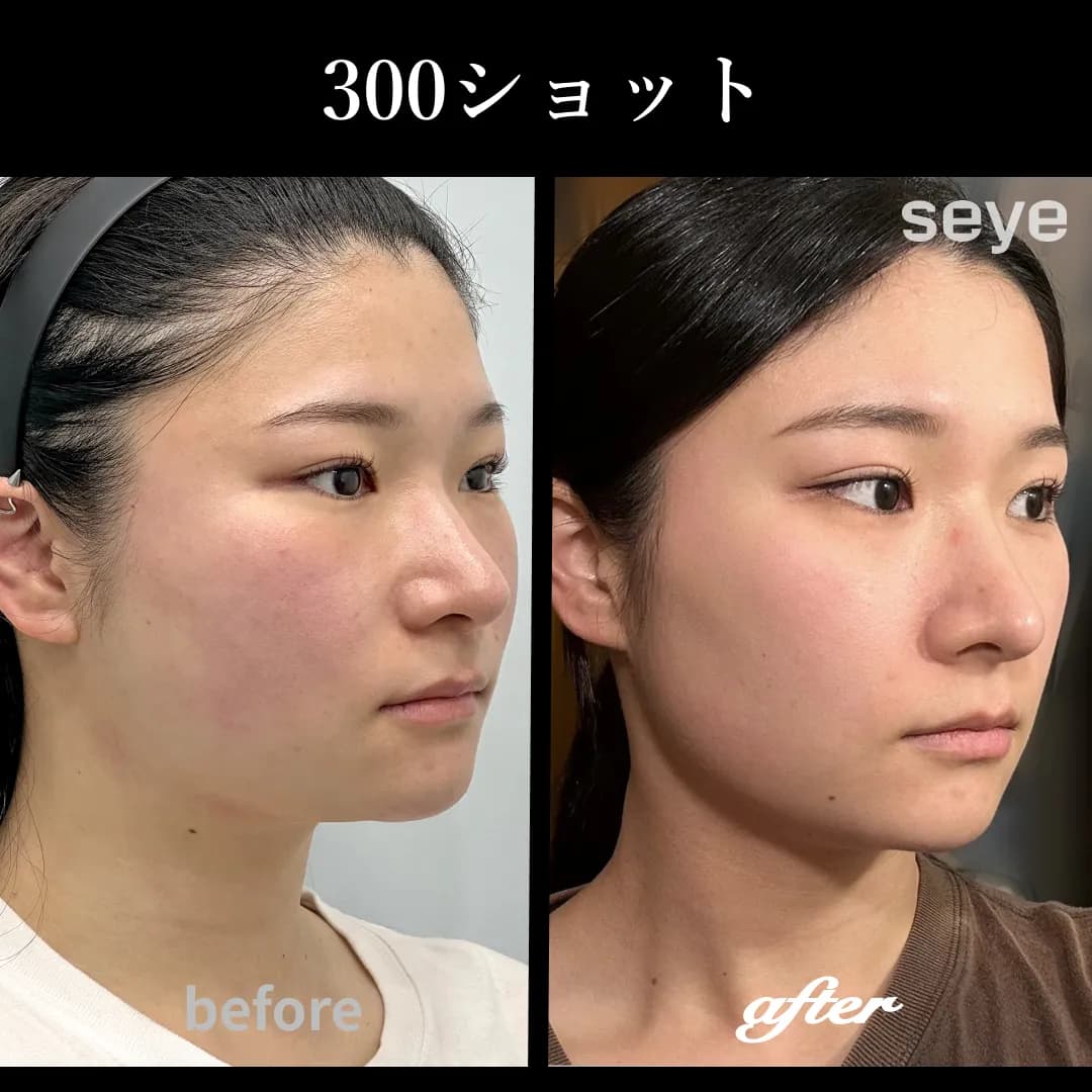 ウルセラプライム__300ショット_症例写真.jpg