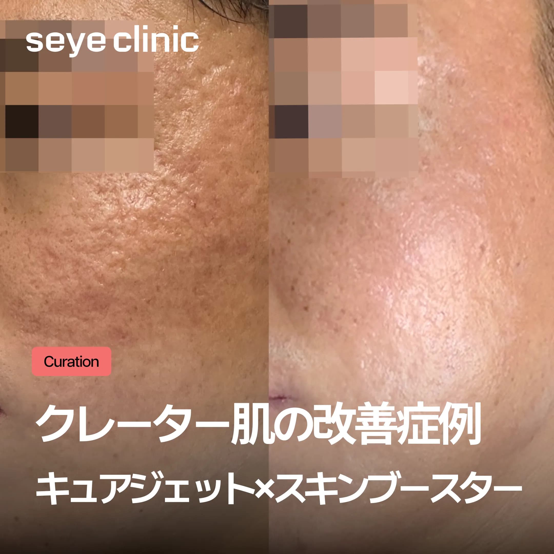 クレーター肌改善の症例レビュー|キュアジェットとスキンブースターを組み合わせたニキビ跡複合アプローチ