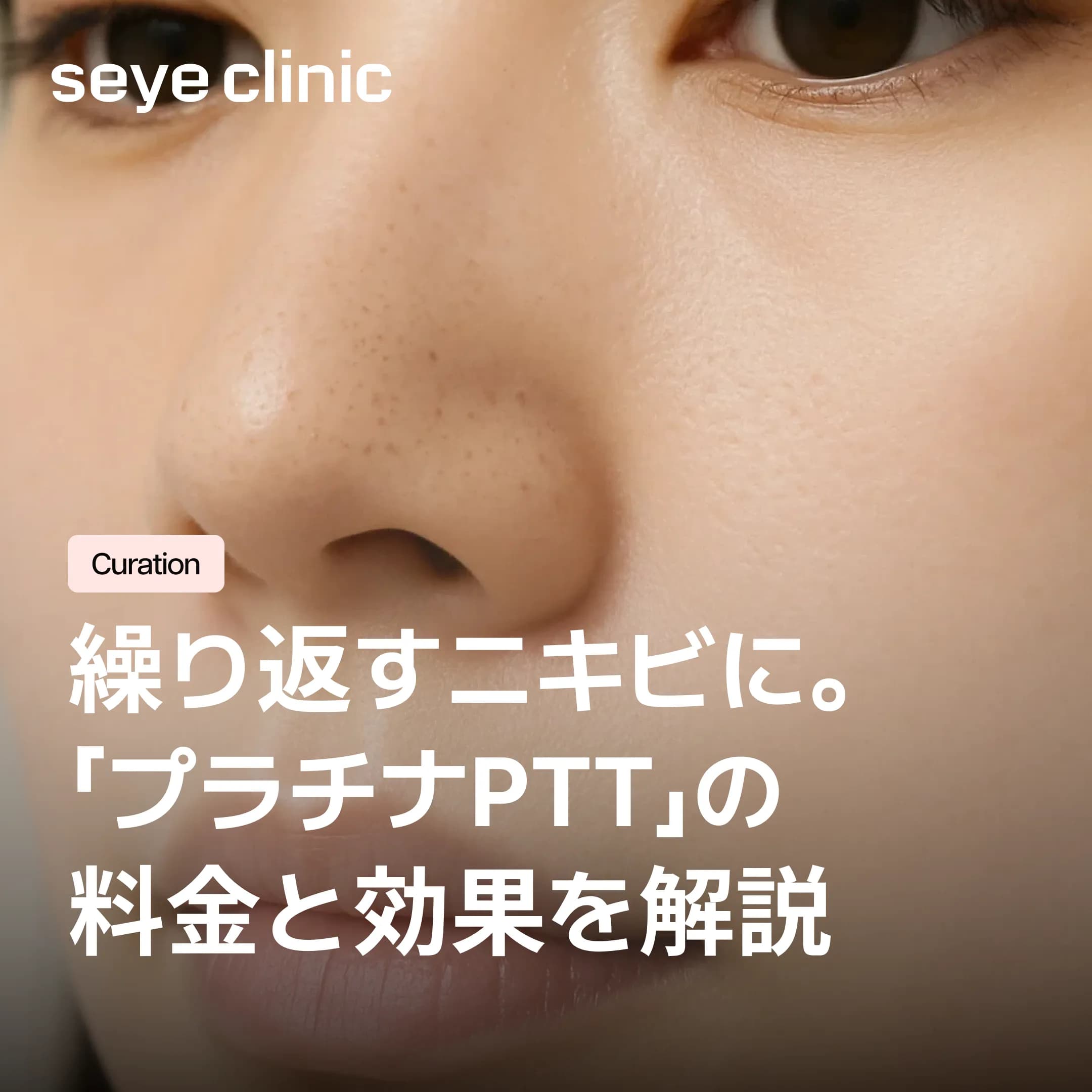 プラチナPTTの料金はいくら?ニキビ治療の費用と価格を決める要因を解説