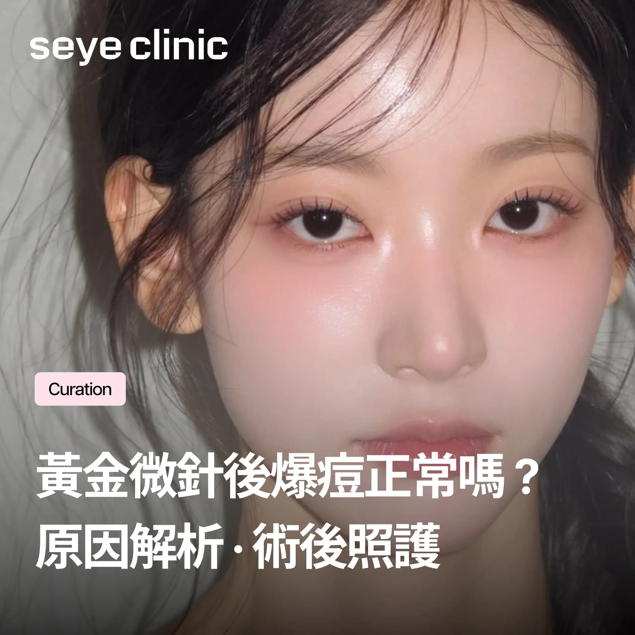 黃金微針Potenza後爆痘是正常的嗎?恢復期判斷與術後照護完整說明