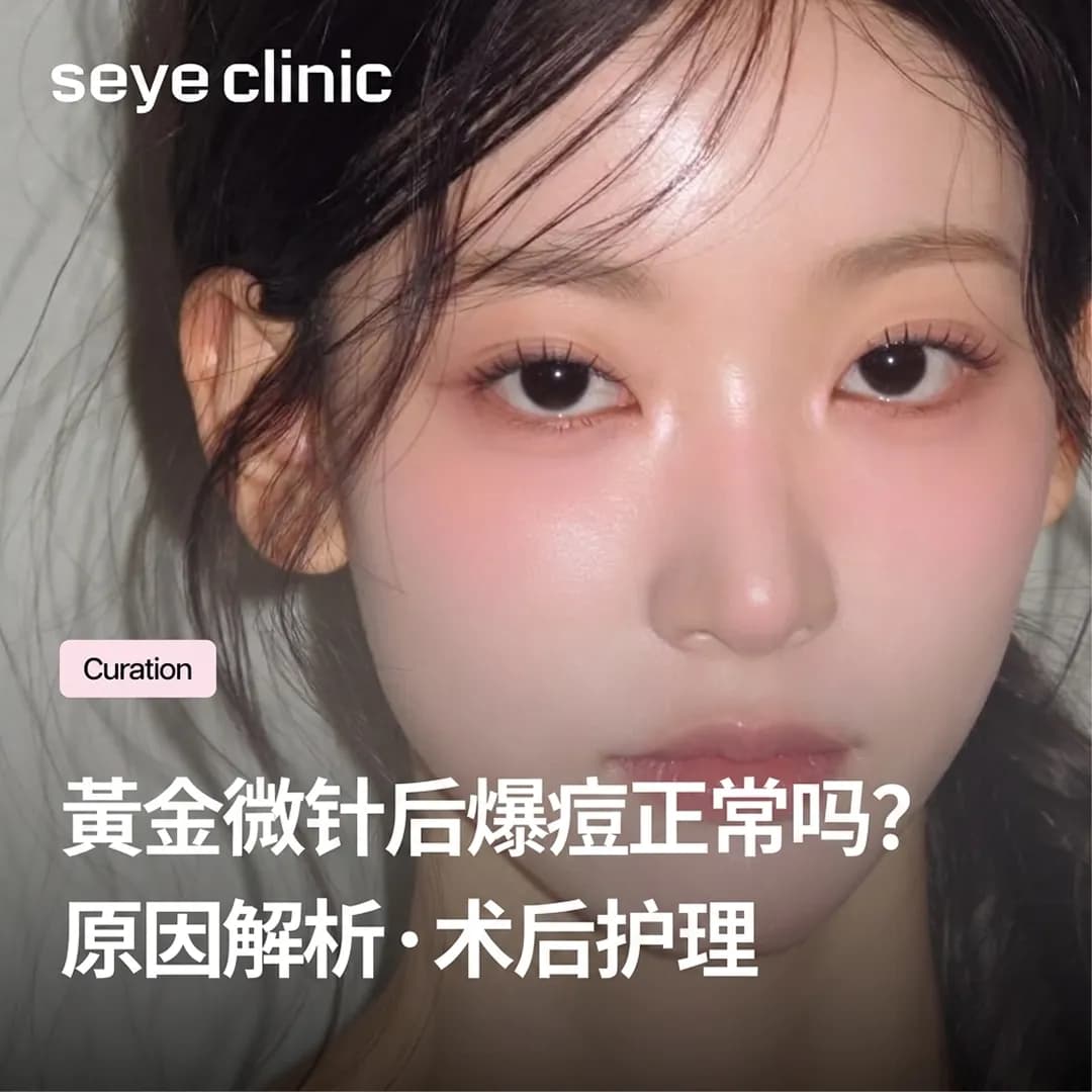 黄金微针Potenza后爆痘是正常的吗?恢复期判断与术后照护完整说明