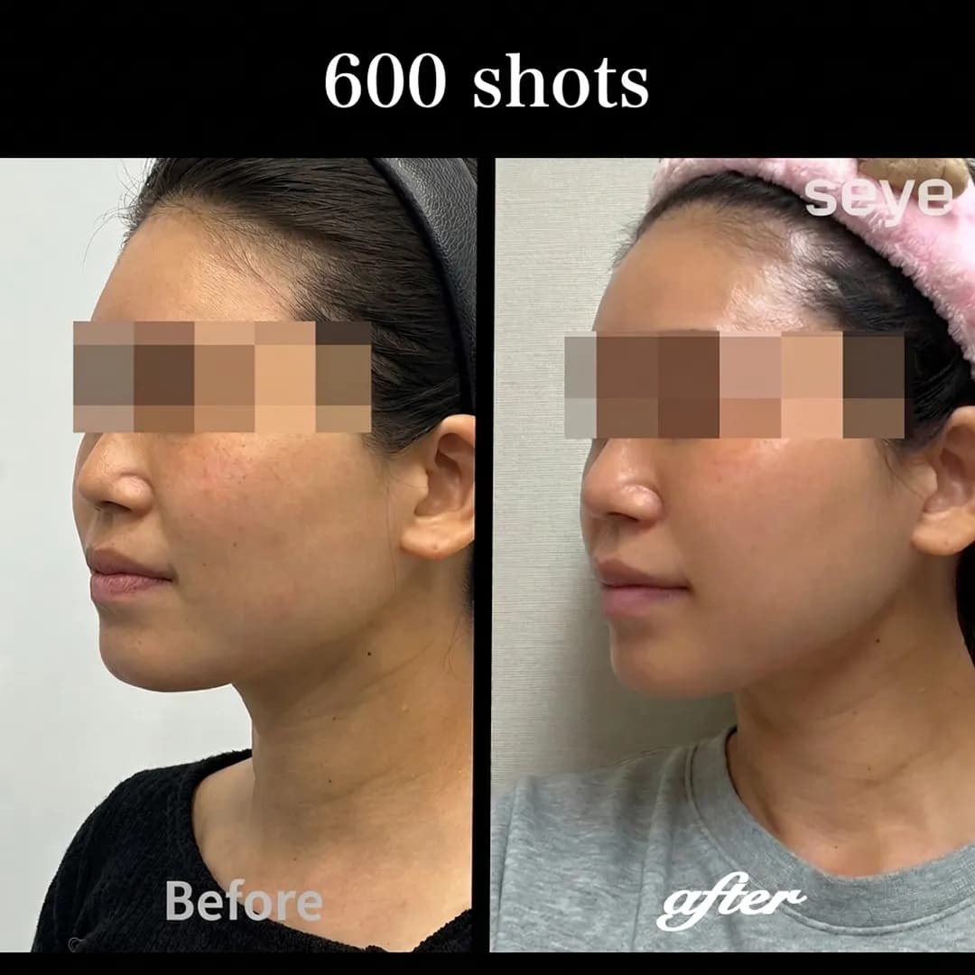 Before and after Ultherapy Prime 600 shots at Seye Clinic, showing significant jawline and neck lifting from a profile view.