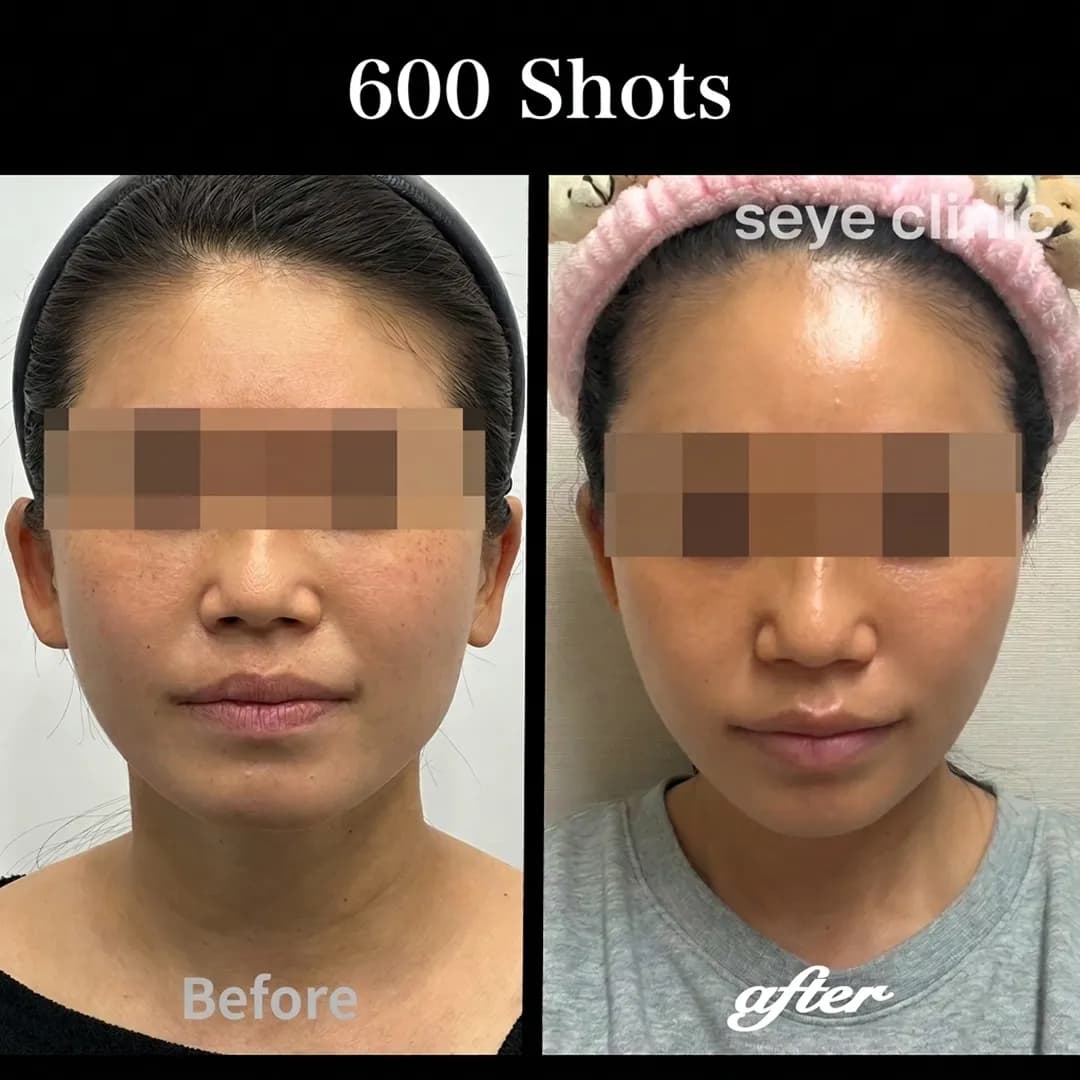 Front view before and after Ultherapy Prime 600 shots, demonstrating overall facial tightening and contour improvement.