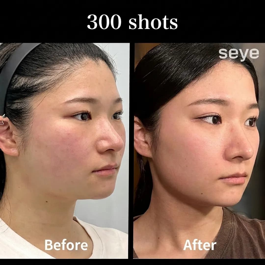 Profile view before and after Ultherapy Prime 300 shots, highlighting improved jawline definition and reduced jowls.