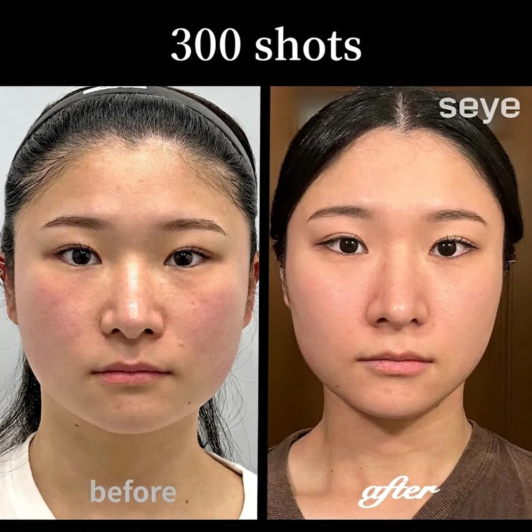 Before and after Ultherapy Prime 300 shots, showing subtle yet effective facial lifting and skin rejuvenation from a frontal view.