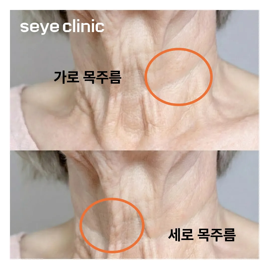 가로목주름 세로목주름 차이.webp