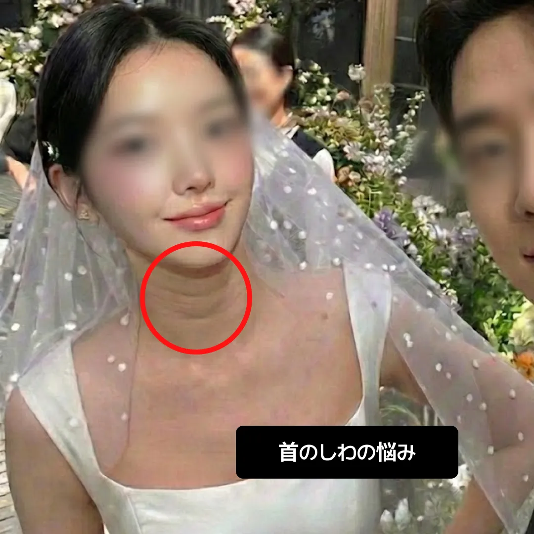 결혼 예신 피부과 시술 목주름-1.webp