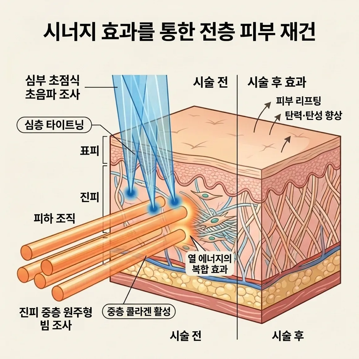 더블하이푸원리.webp