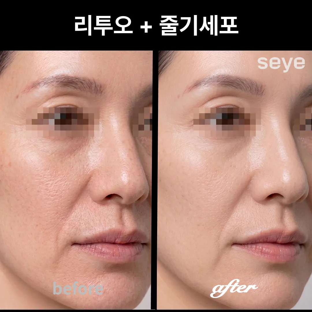 리투오, 줄기세포 전후-1.webp
