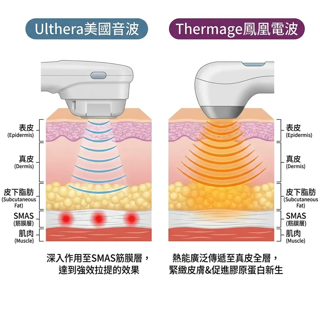 써마지-울쎄라-차이-Subcutaneous-Fat-Thermage鳳凰電波-Ulthera美國音波-Epidermis-zh-tw.webp