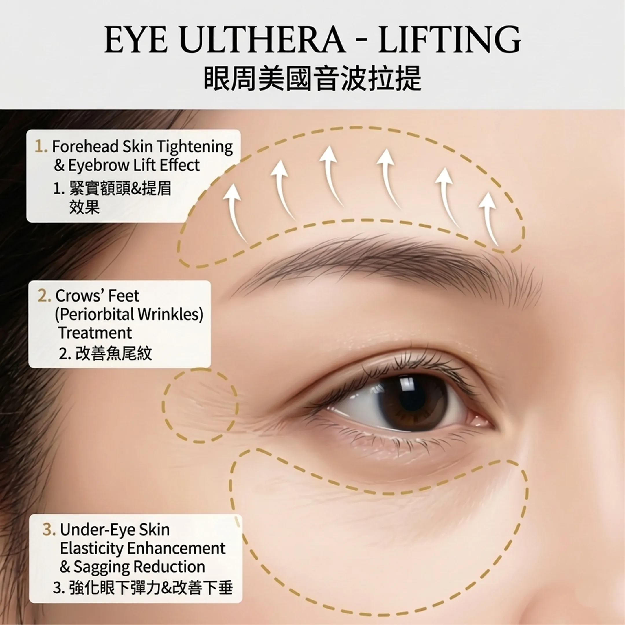 아이울쎄라-效果-眼周-美國音波-拉提-1-Forehead-Skin-Tightening-Eyebrow-Lift-Effect-EYE-ULTHERA-LIFTING-zh-tw.webp