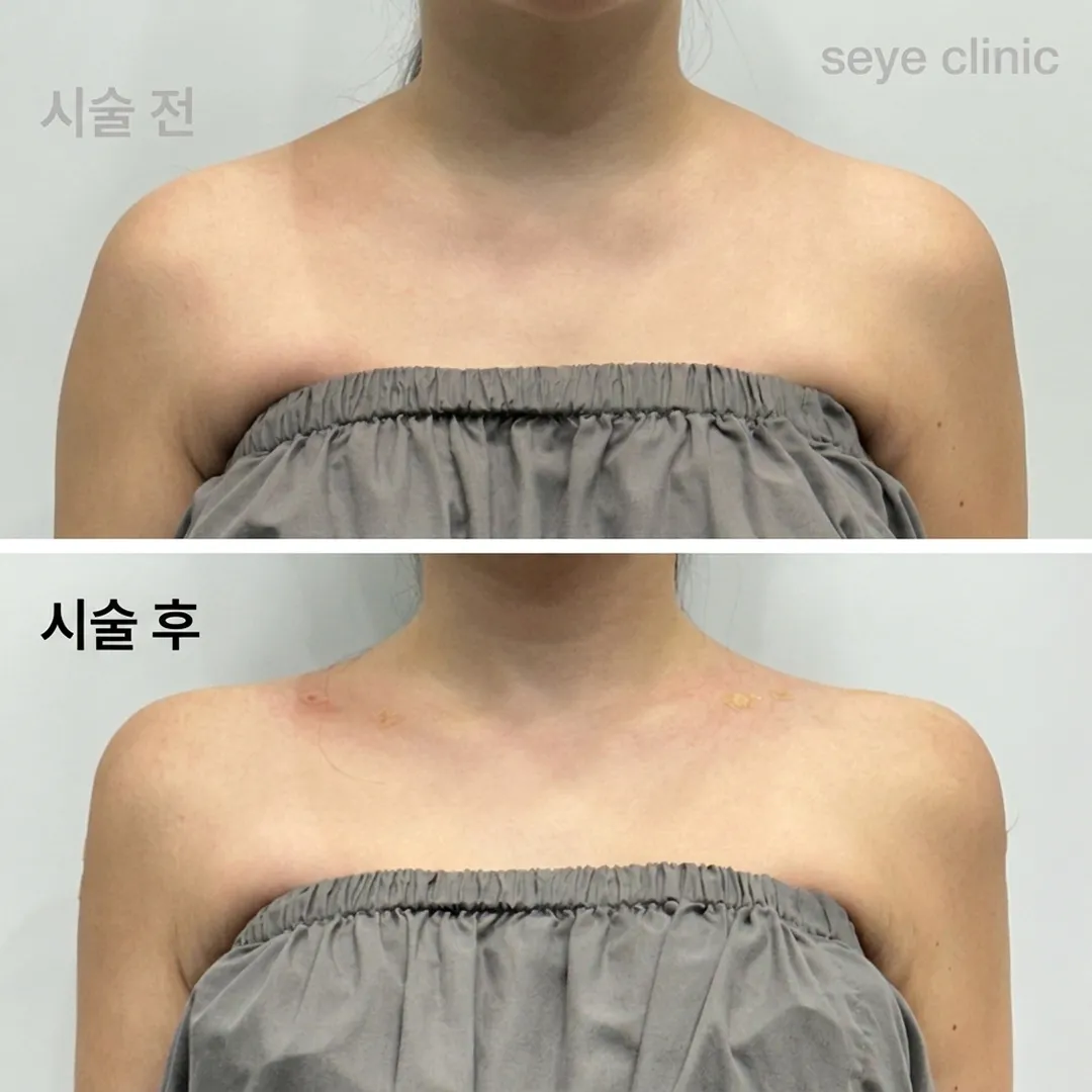 어깨필러_전후.webp