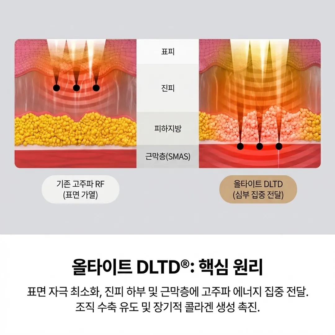 올타이트 리프팅 원리 DLTD.webp