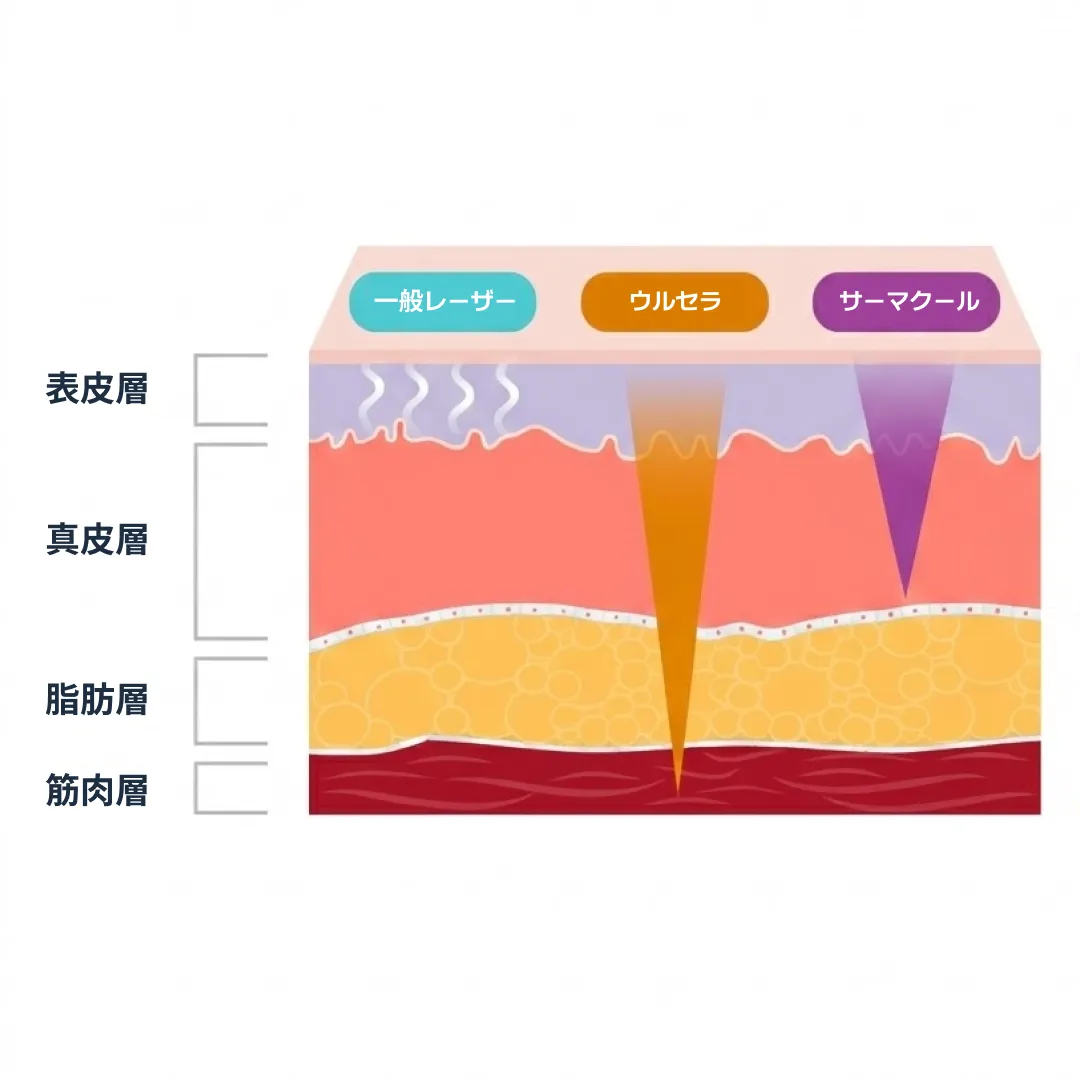 울쎄라 써마지 차이-1.webp