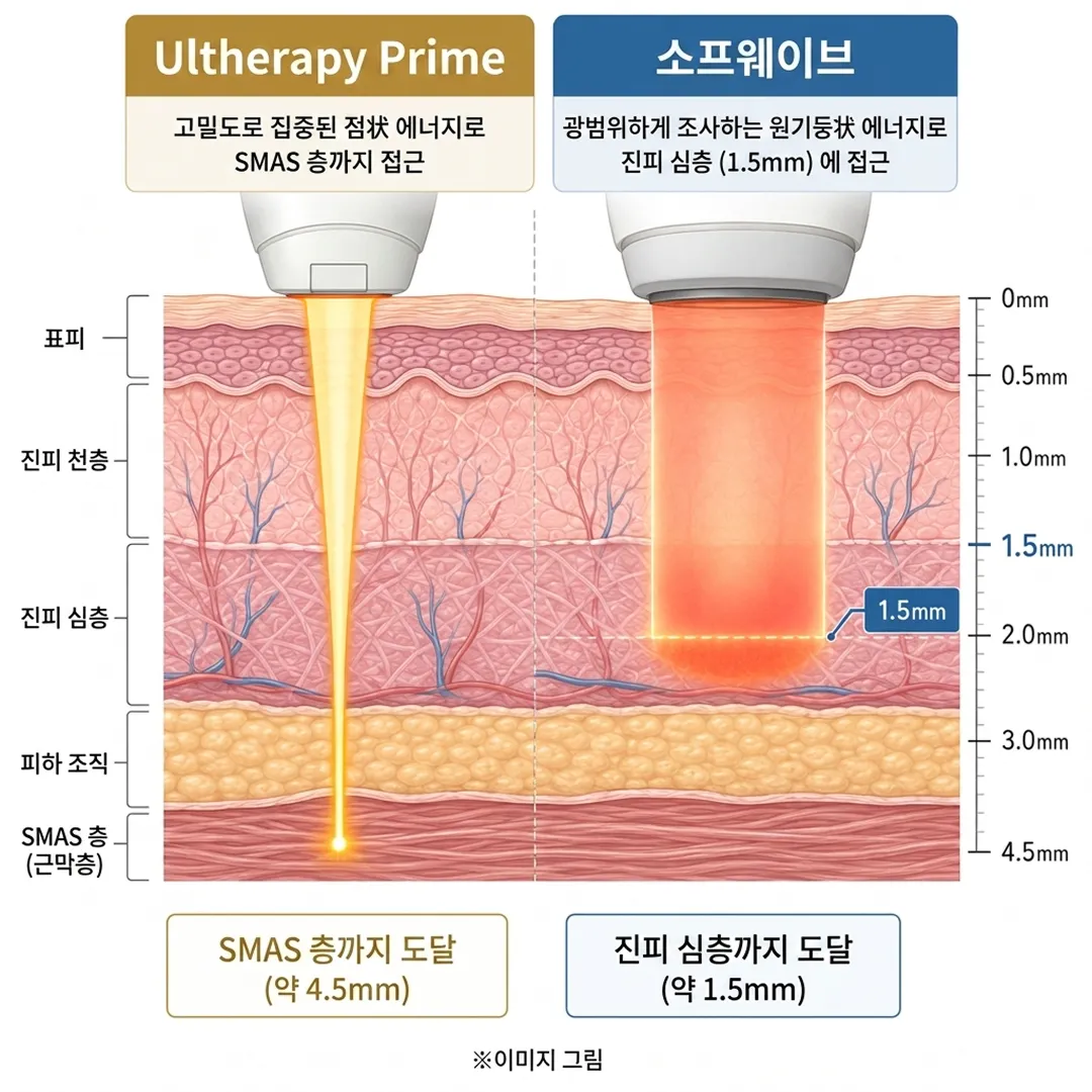울쎄라프라임vs. 소프웨이브.webp