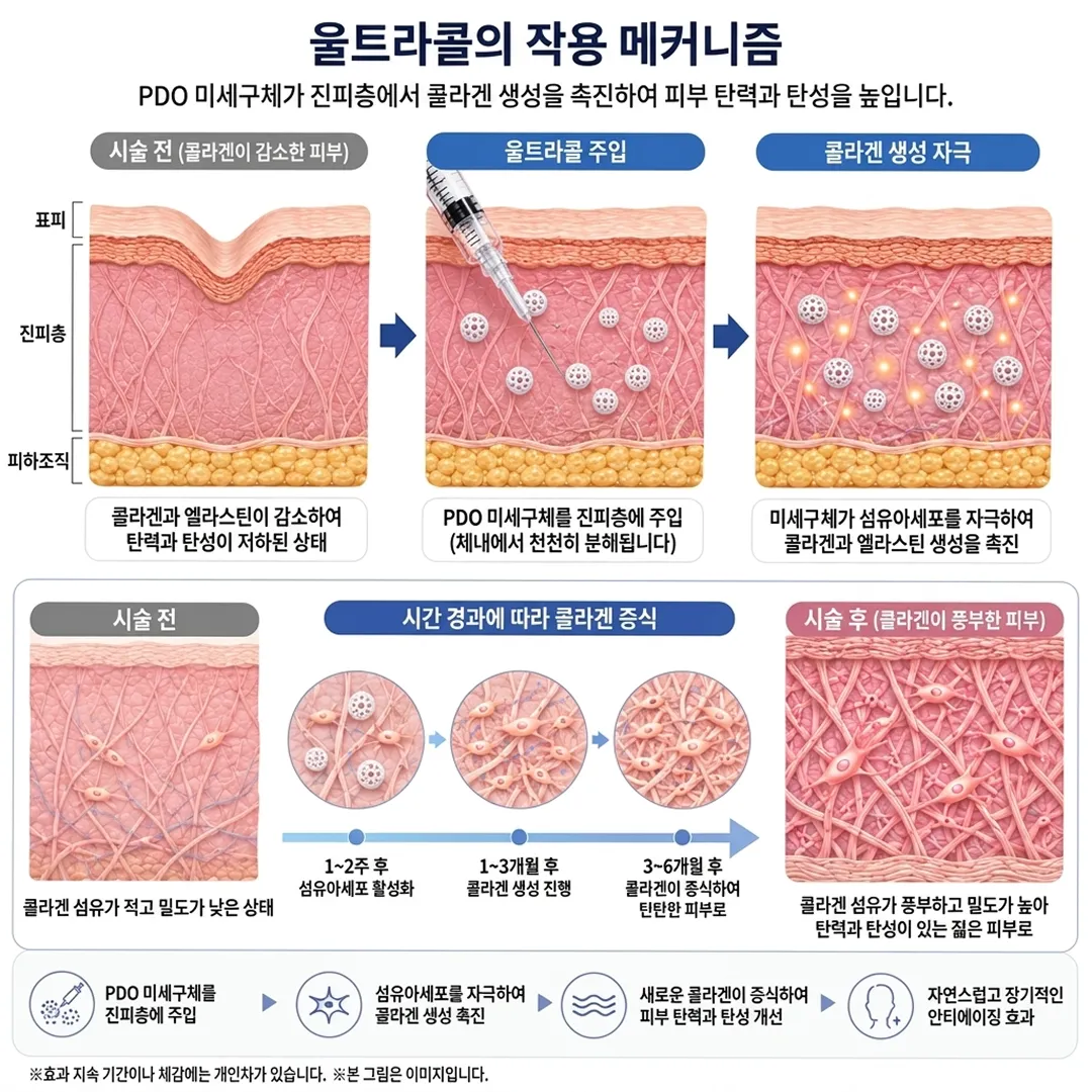 울트라콜 원리와 효과.webp