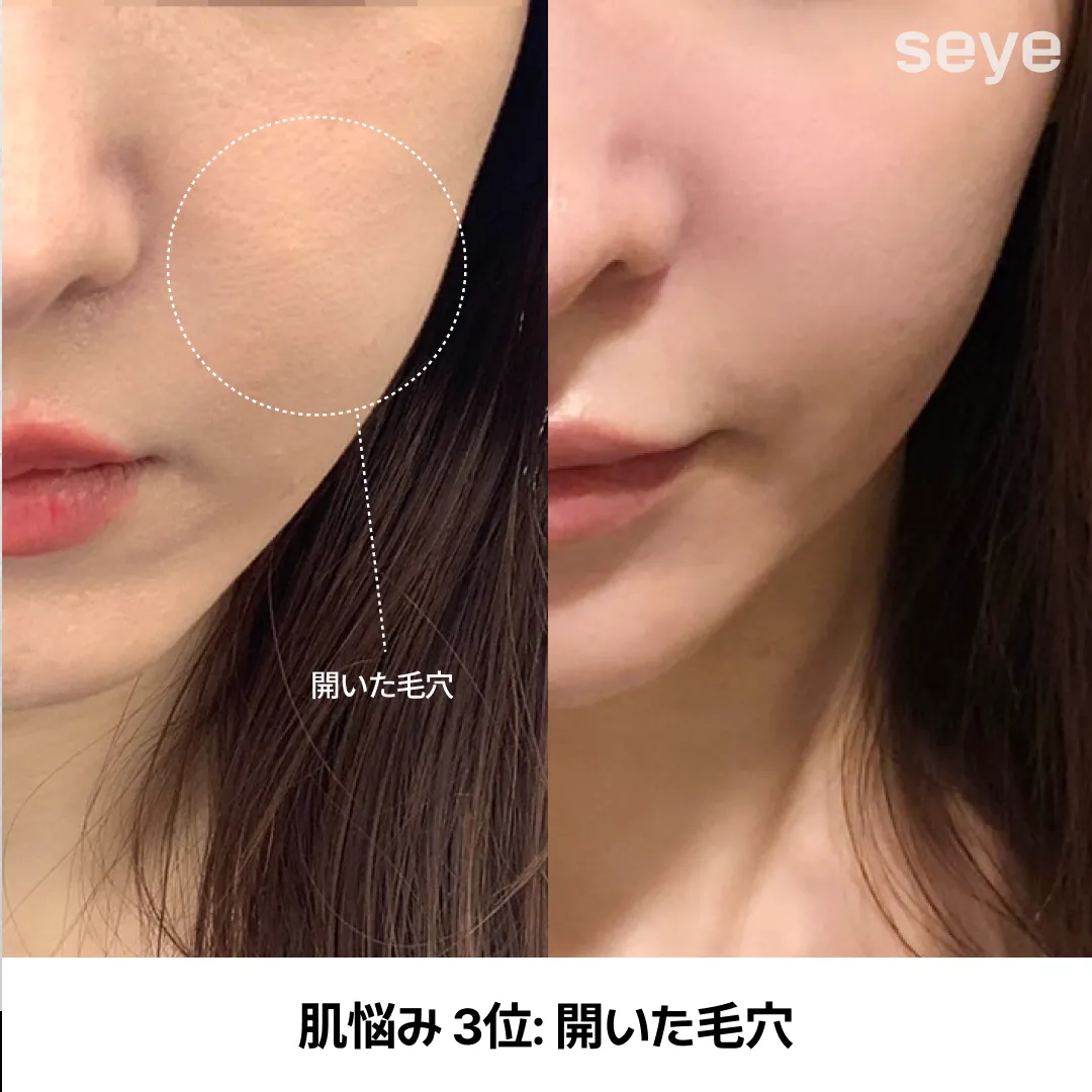 피부 고민 모공 축소-1.webp