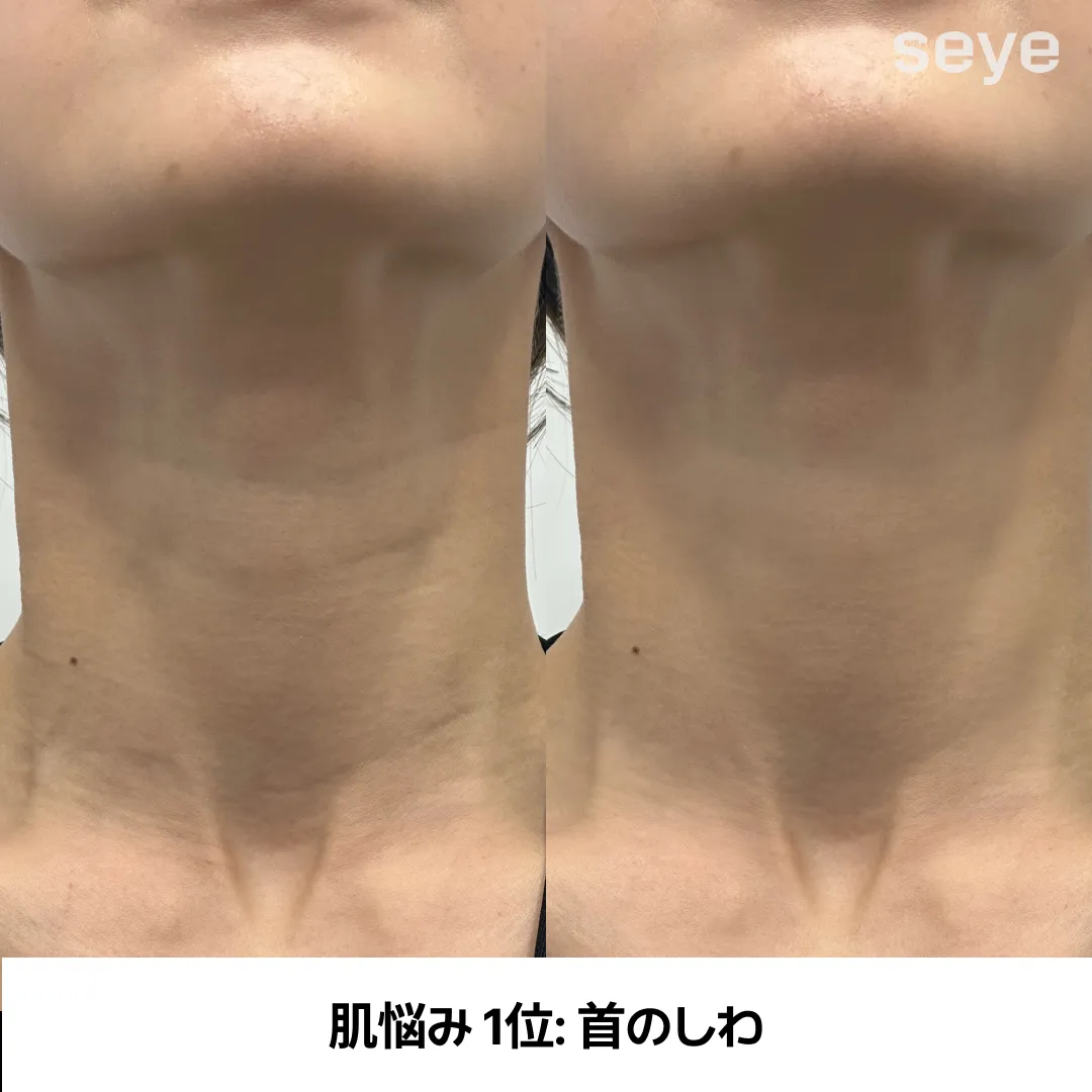 피부 고민 목주름-1.webp