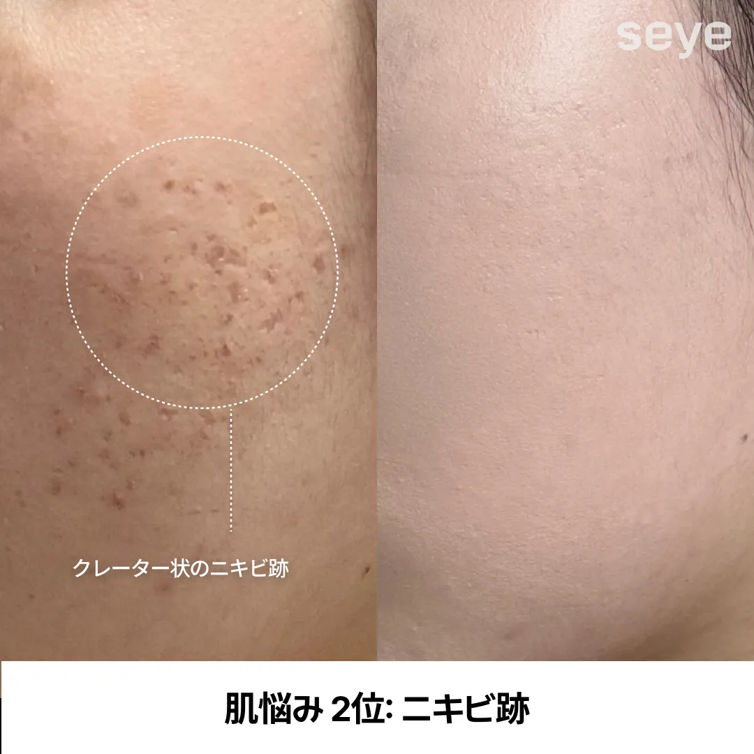 피부 고민 여드름 흉터-2.webp
