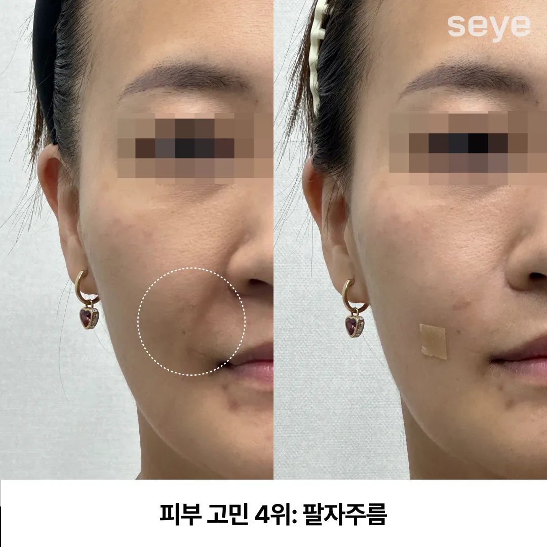 피부 고민 팔자주름.webp