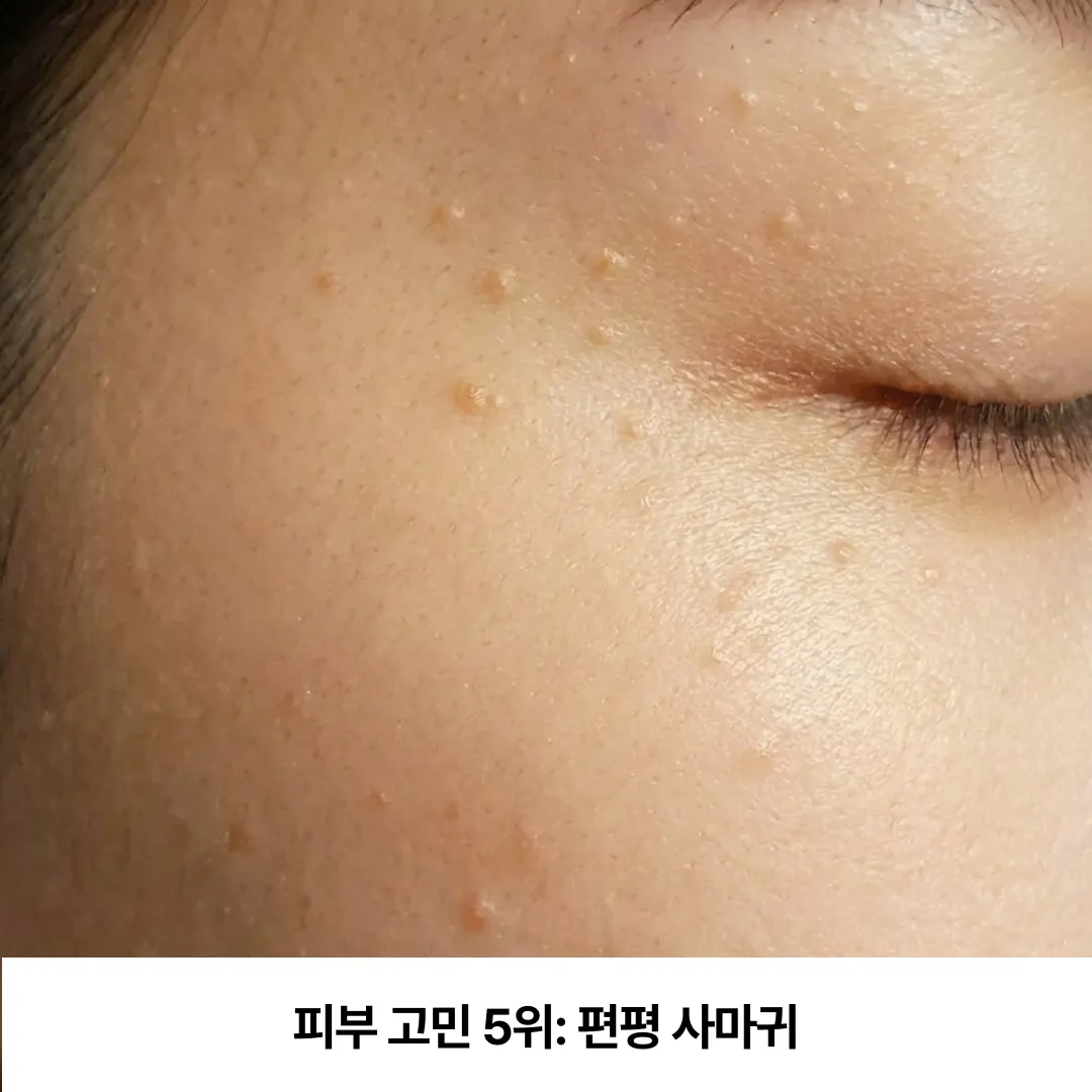 피부 고민 편평 사마귀.webp
