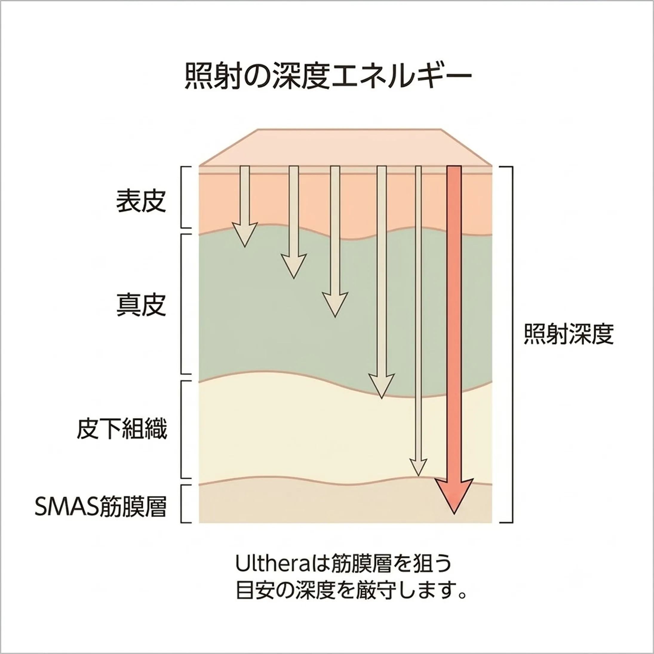 ウルセラとHIFUの作用メカニズム-1.webp