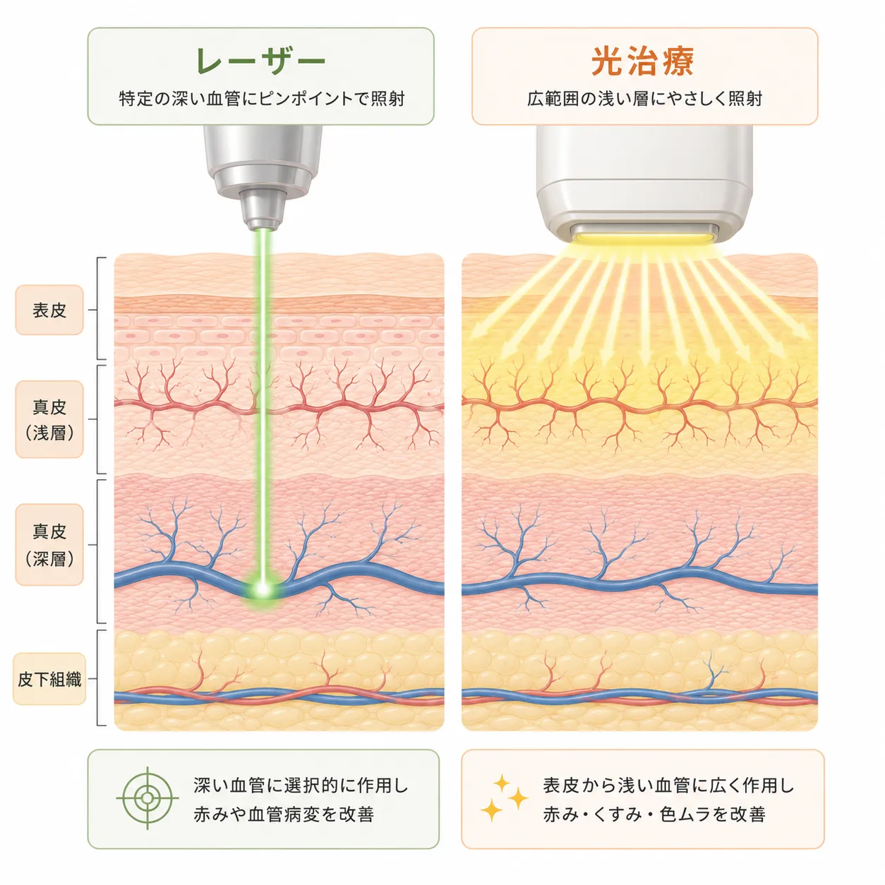 エクセルVとBBLの照射範囲の違い.webp
