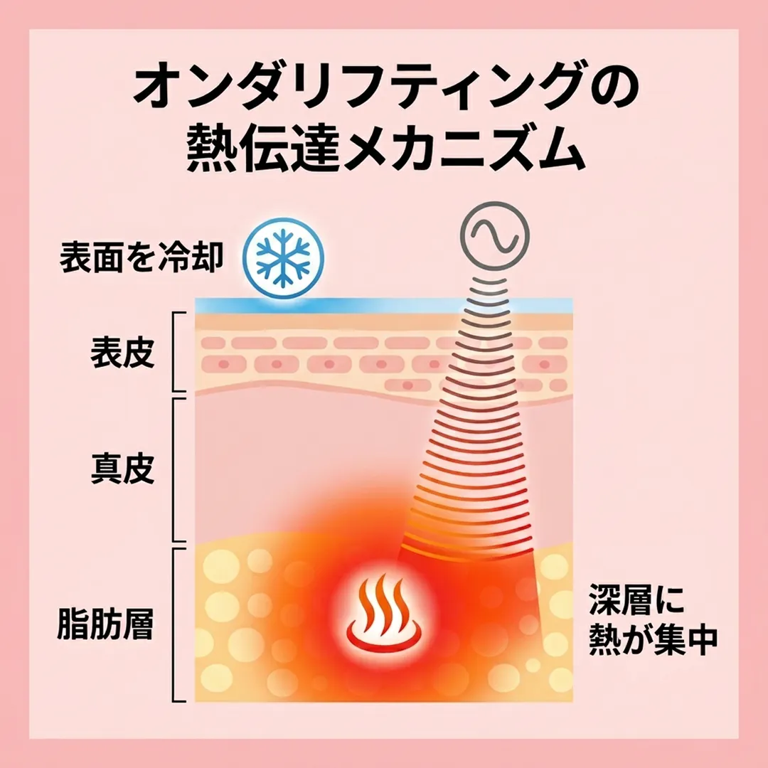 オンダリフティング　メカニズム.webp