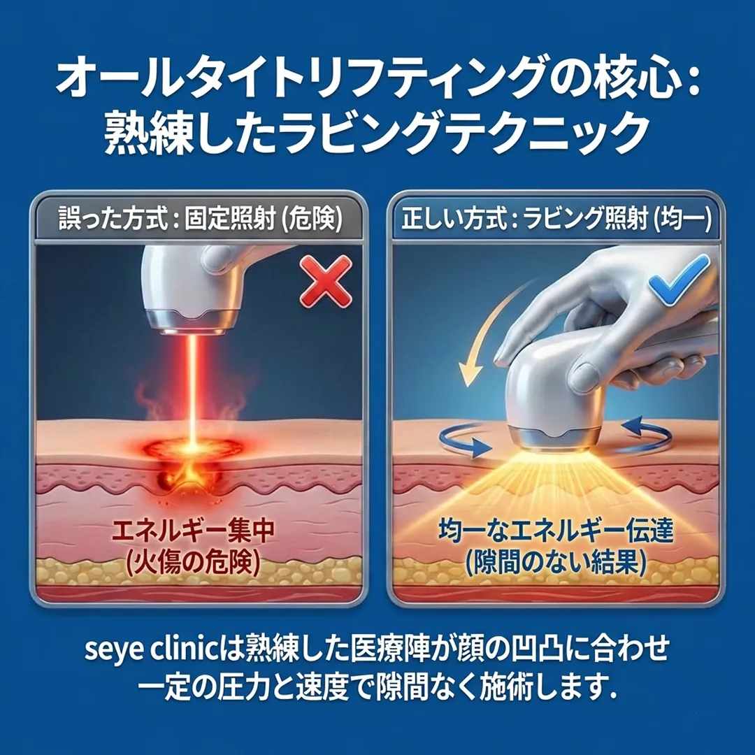 オールタイト-江南-美容クリニック-正しい方式：ラビング照射-均一-誤った方式：固定照射-危険-オールタイトリフティングの核心：-熟練したラビングテクニック-ja.webp