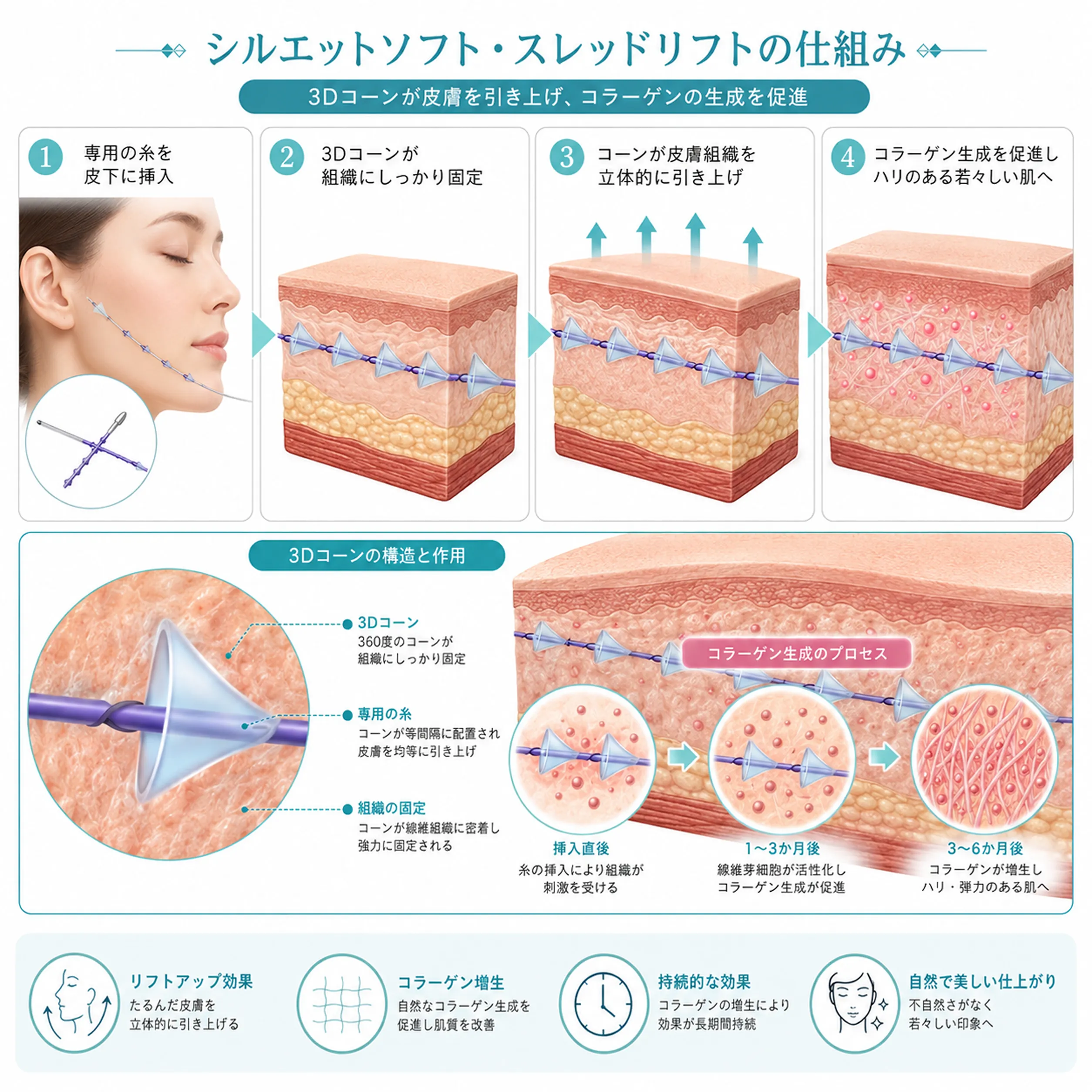 シルエットソフトリフトのメカニズム図解.webp