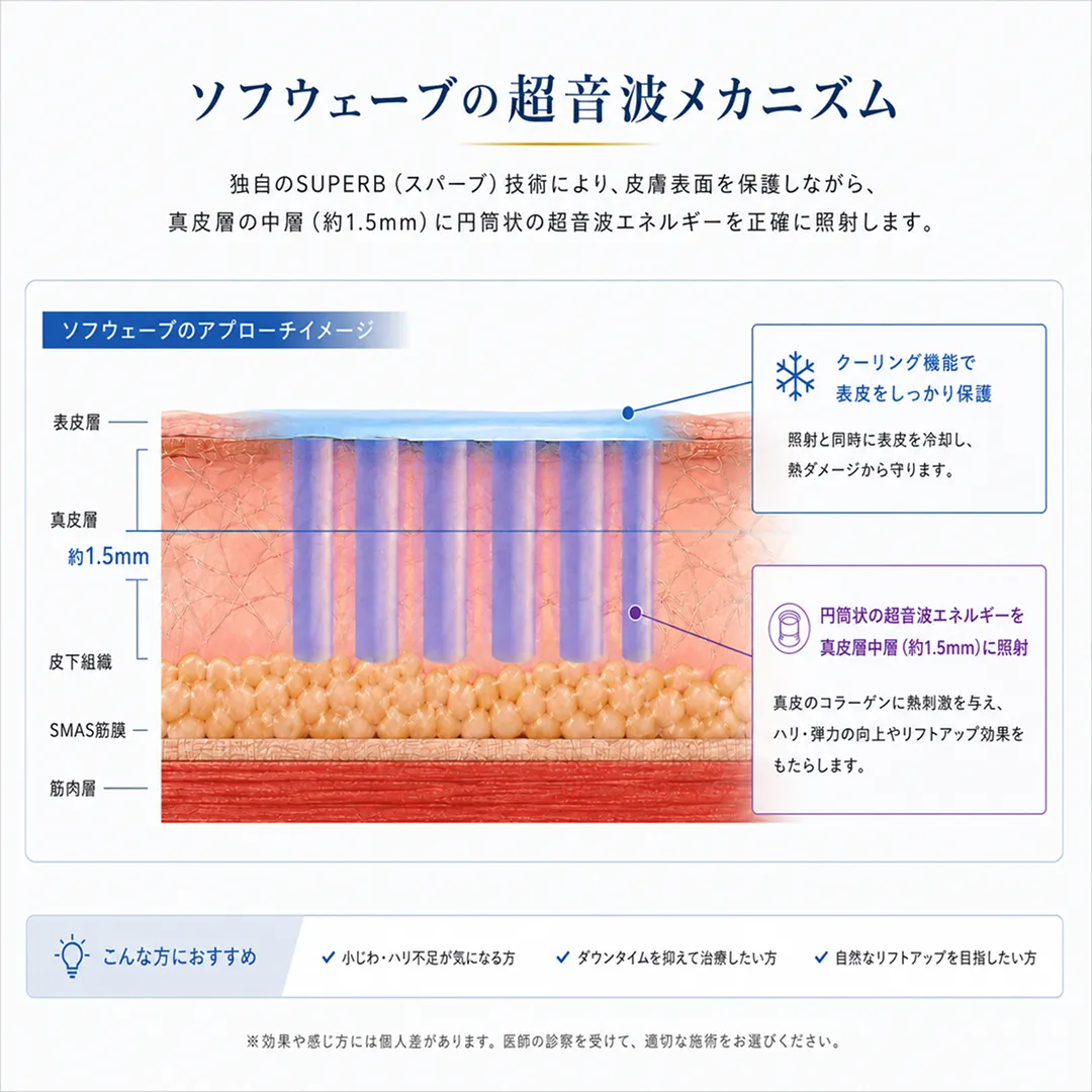 ソフウェーブのメカニズム-3.webp