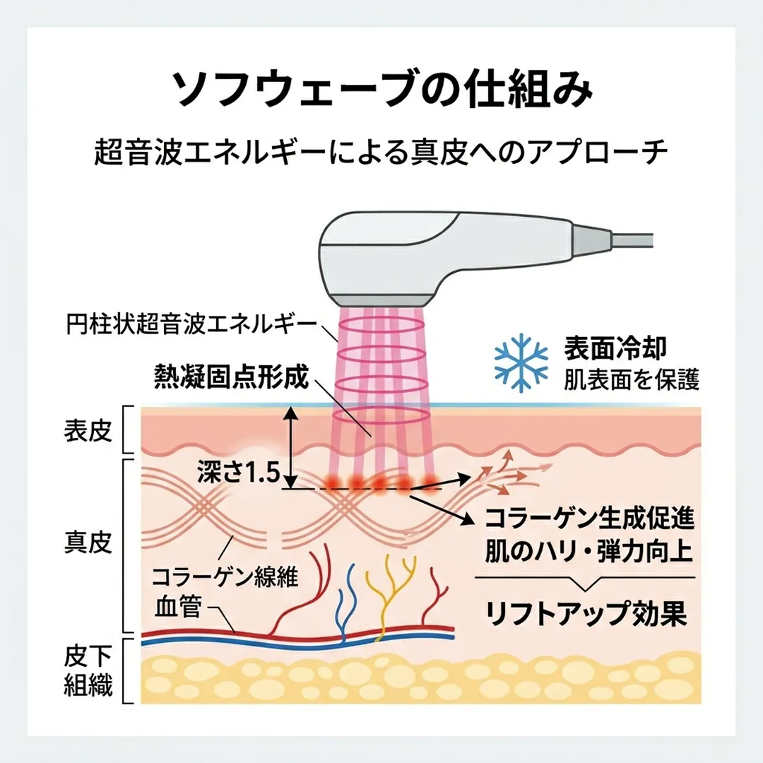 ソフウェーブのメカニズム-1.webp