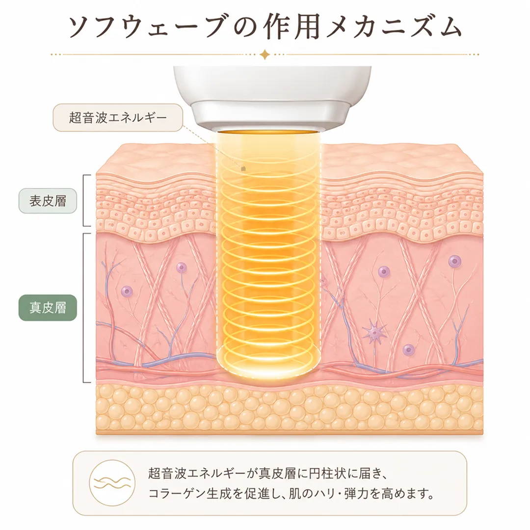 ソフウェーブの作用メカニズム.webp