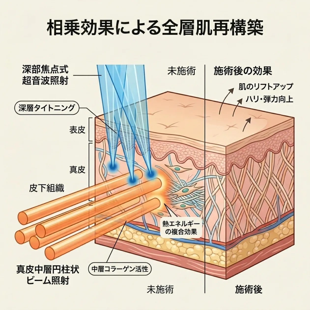 ウルセラピープライムとソフウェーブを組み合わせることで皮膚全層が強化される相乗効果の図解