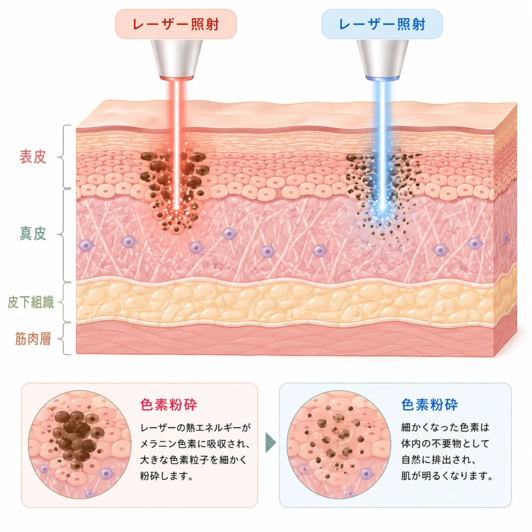 ピコシュアプロとピコプラスが肌の色素を細かく粉砕する原理を示した医療イラスト.webp