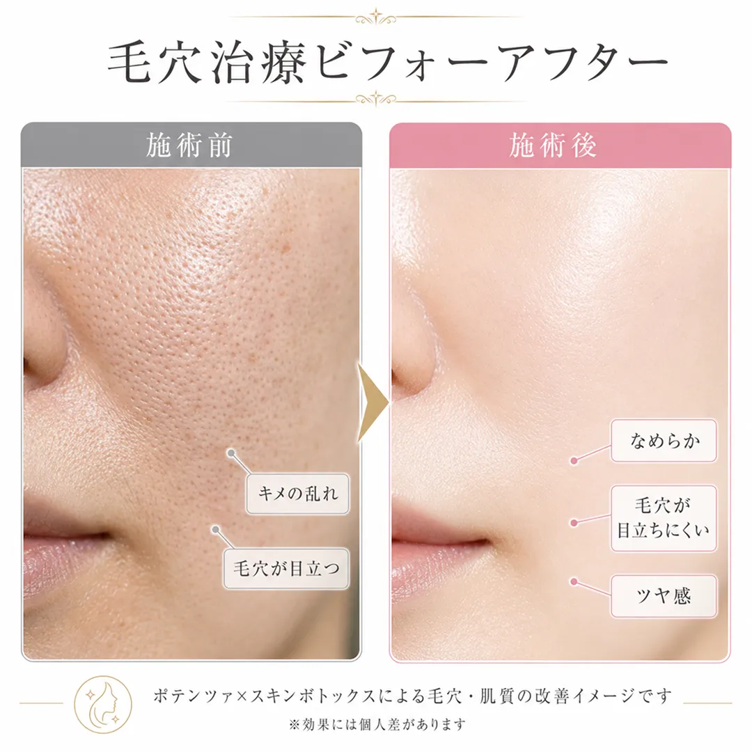 ポテンツァとスキンボトックスの複合施術による毛穴改善のビフォーアフター.webp