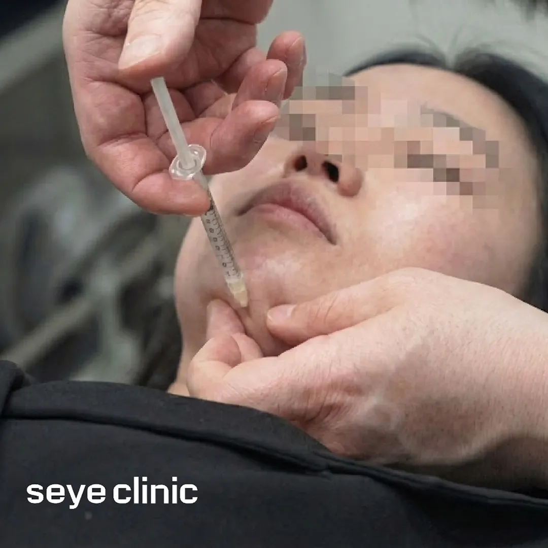 二重アゴ注射-seye-clinic-ja.webp