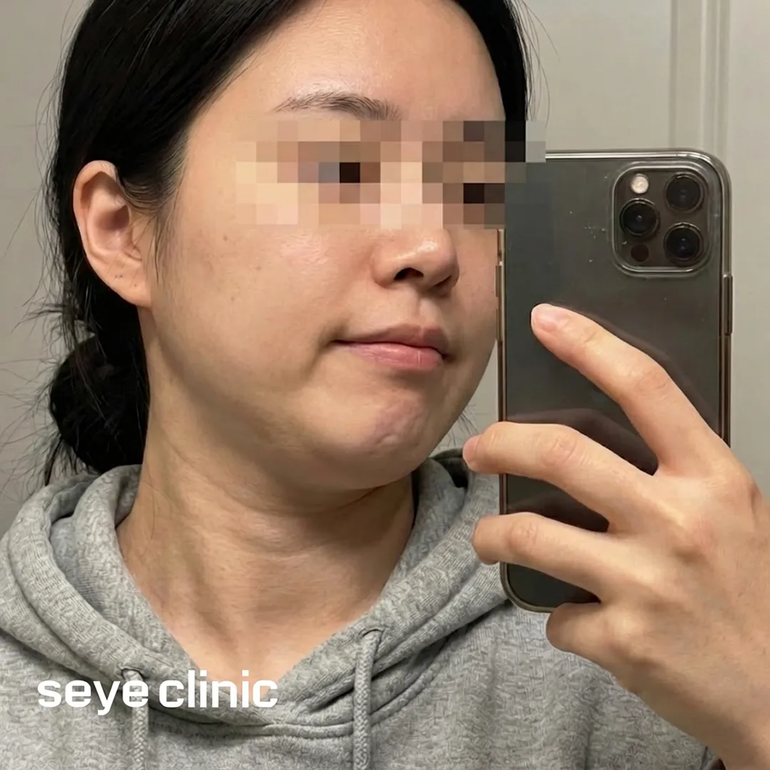 二重アゴ-リフティング-口コミ-seye-clinic.webp