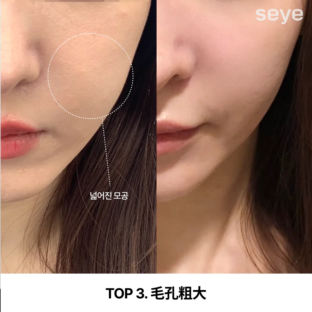 毛孔粗大-1.webp